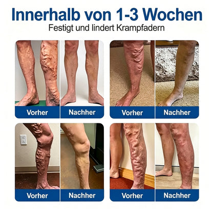 Offizieller Markenstore 30% 𝑭𝒍𝐨𝐫𝒊𝘀𝒎𝙖® 𝑽𝒆𝒊𝒏𝑻𝒂𝒓𝒈𝒆𝒕 𝑴𝒊𝒌𝒓𝒐𝒏𝒂𝒅𝒆𝒍-𝑷𝒇𝒍𝒂𝒔𝒕𝒆𝒓 ⚡ Sofortige Linderung, langfristige Wirkung🎁🎁