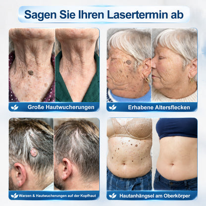 𝑷𝑖𝒄𝐝𝐨®✅🎉7-𝑻𝒂𝒈𝒆 𝑯𝒂𝒖𝒕𝒂𝒏𝒉ä𝒏𝒈𝒔𝒆𝒍- & 𝑭𝒍𝒆𝒄𝒌𝒆𝒏𝒆𝒏𝒕𝒇𝒆𝒓𝒏𝒆𝒓(Schmerzfreier Rollerball – Keine Narbenbildung)